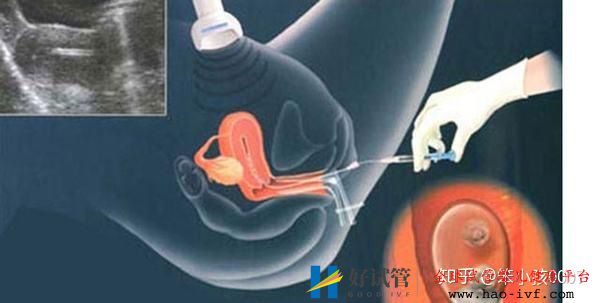 42岁试管终于移植成功,惊喜之余竟有这么多事项需...(图1) 42岁试管终于移植成功,惊喜之余竟有这么多事项需...(图1)