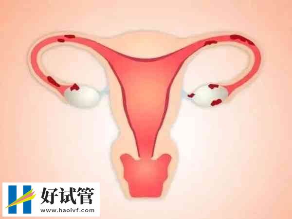 输卵管积水会不会导致胎停(图1)
