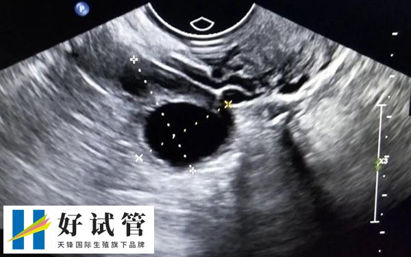 卵泡位置高低影响取卵成功率