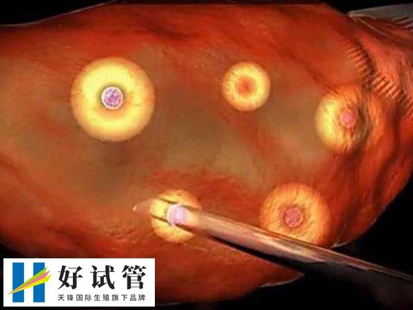 取卵数量一般在8到15个之间