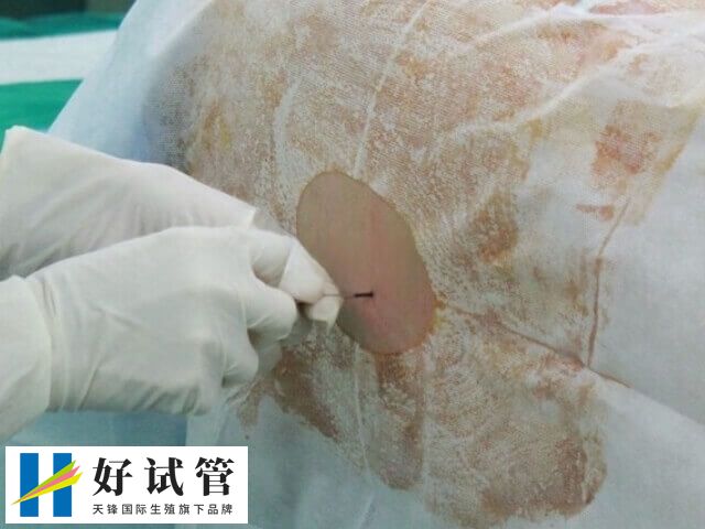 宫腔镜是一种微创性妇科诊疗技术