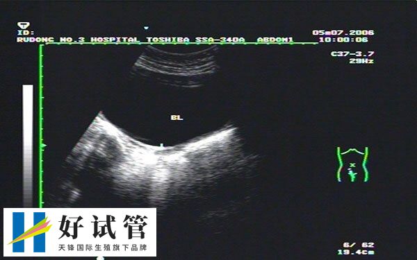 超声检查可以确定受精卵的发育情况和大小