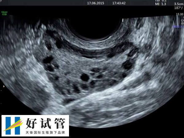 多囊卵巢是一种常见的内分泌失调疾病