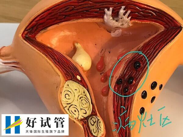 子宫腺肌症是一种常见的妇科疾病