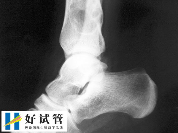 骨肉瘤是一种高度恶性的骨肿瘤