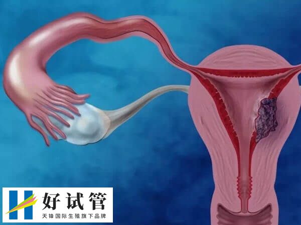 多囊卵巢会引起不孕不育